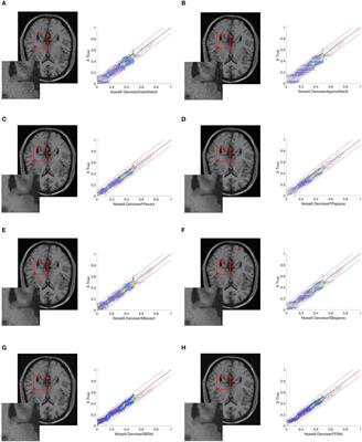 Magnetic resonance imaging enhancement using prior knowledge and a denoising scheme that combines total variation and histogram matching techniques